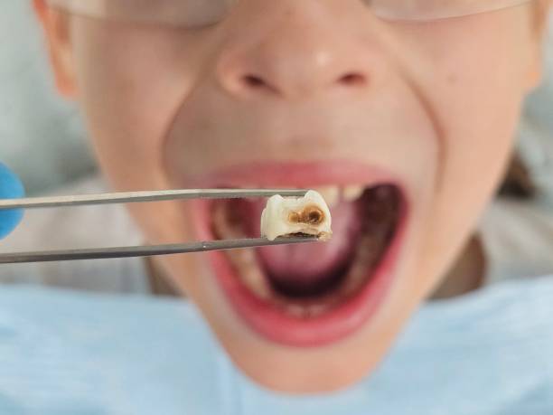 Best Emergency Broken Tooth Repair in Hooper, UT
